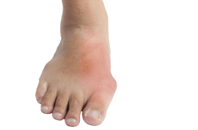 Gout Symptoms And Causes   Gout Toe 1.ashx